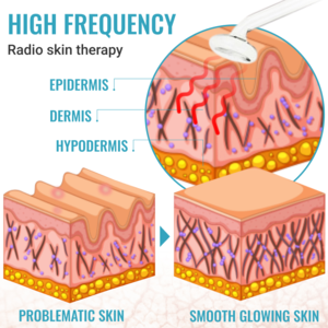 High Frequency Massager, High Frequency Wand Anti Age Hair Loss Wrinkles Acne