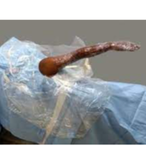 Shoulder Arthroscopy Drape