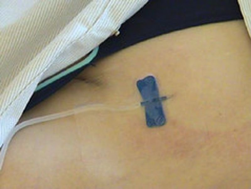 Infusion Set